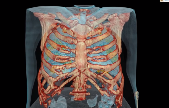  Κοροναϊός: 3D βίντεο δείχνει πώς καταστρέφει τους πνεύμονες
