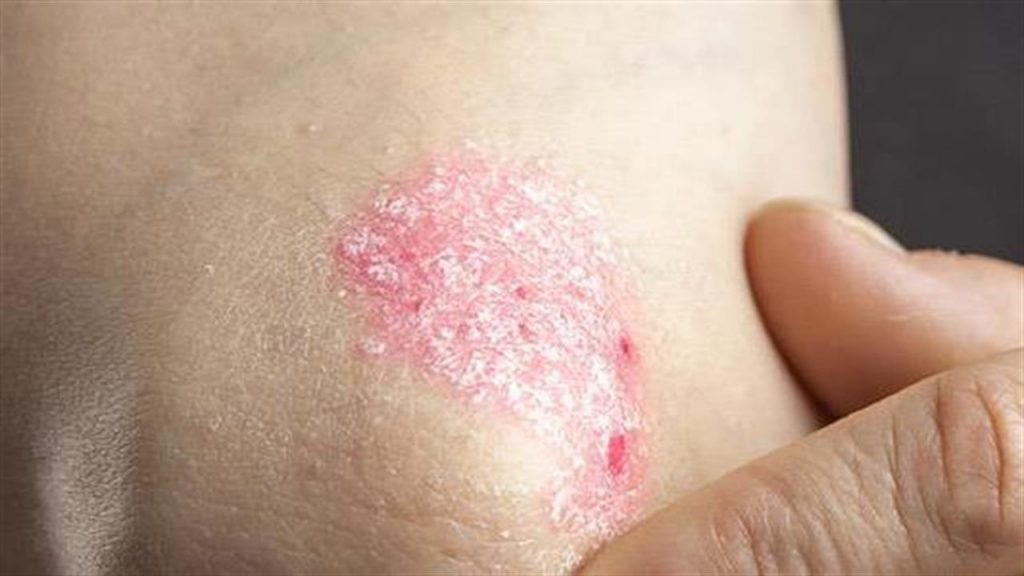 43181 psor elbow 660