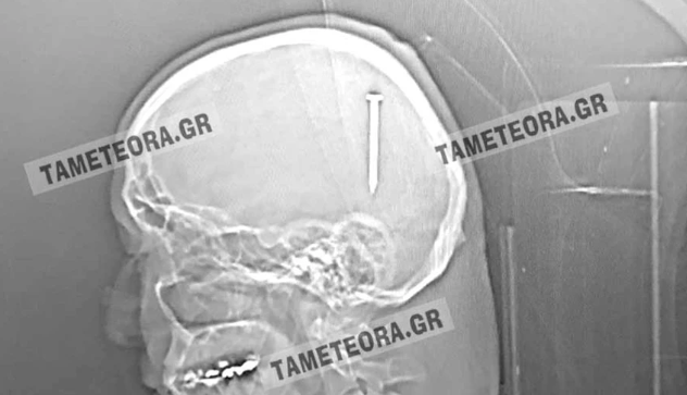  Καρφί 5 εκατοστών καρφώθηκε στο κεφάλι άνδρα κατά τη διάρκεια εργασιών