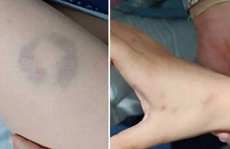  Απίστευτο περιστατικό: Διευθύντρια δάγκωσε μαθητή στην Άρτα