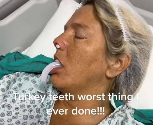  “Δόντια Τουρκίας”: 35χρονη Βρετανή πήγε να φτιάξει τα δόντια της στην Τουρκία και περιγράφει τη φρίκη που έζησε