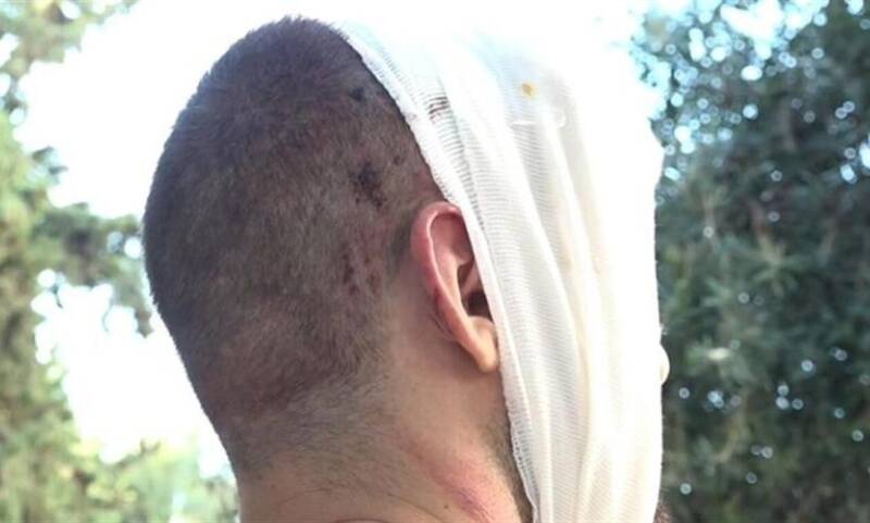  Allou fun park/Μαρτυρία τραυματία: “Το βαγόνι δεν φρέναρε” – “Έκανα 12 ράμματα στο κεφάλι”