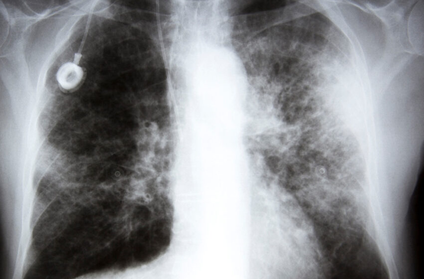  Καρκίνος πνεύμονα: Ταχύτατα εξελισσόμενες θεραπείες – Έγκαιρη διάγνωση, σωτηρία ζωής – Μιλά στο libre ο χειρουργός Κ. Μαρκόπουλος