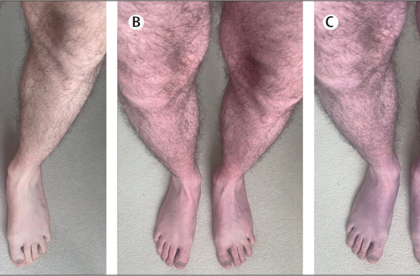  Οι επιστήμονες εντόπισαν νέο σύμπτωμα μακράς COVID – Μελανιάζουν τα πόδια του ασθενή