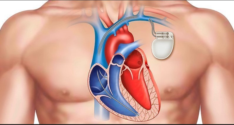  ΗΠΑ: Βηματοδότης επαναφορτίζει την μπαταρία  με τους καρδιακούς παλμούς του ασθενούς
