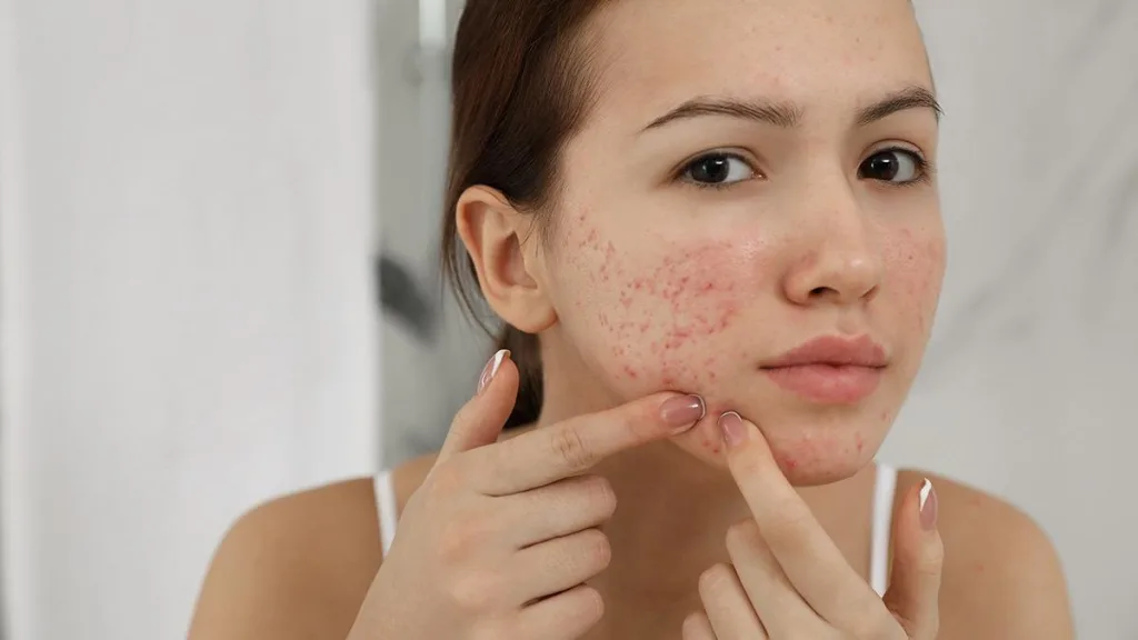 kremes akmi karkinogones ousies venzolio