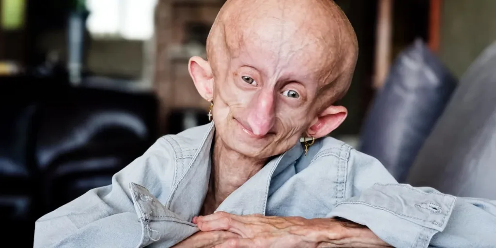 Beandri Booysen pethane 19xroni progiria