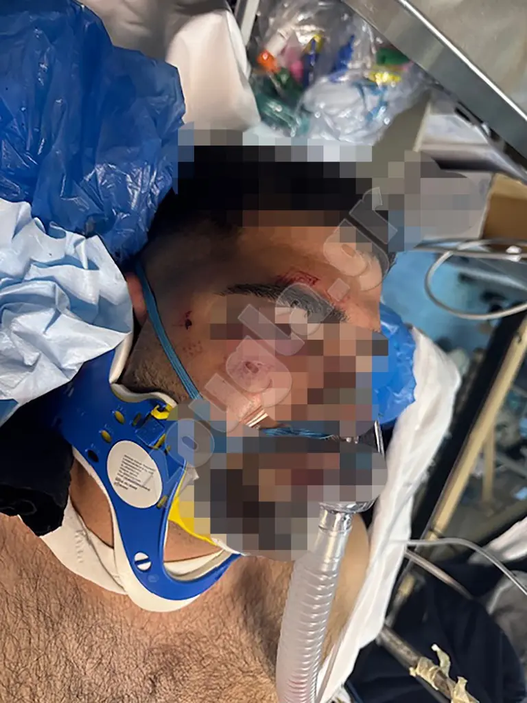 Εικόνες σοκ μετά τον άγριο ξυλοδαρμό 20χρονου από αστυνομικό- Πώς συνέβη το περιστατικό- Διατάχθηκε έρευνα στην ΕΛΑΣ 2 Travmatias ar 3