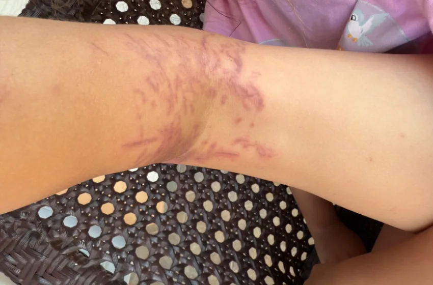  Τζιά: Θαλάσσια ανεμώνη τσίμπησε 6χρονη- Εσπευσμένα στην Αθήνα για νοσηλεία