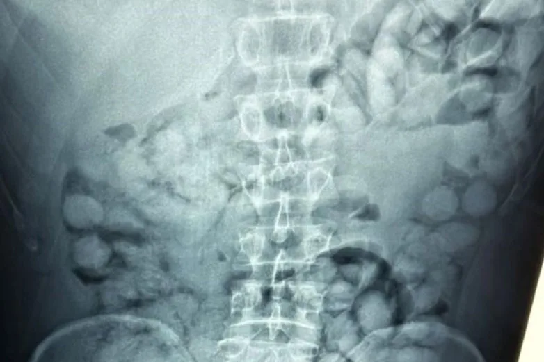  ”Ελ. Βενιζέλος”: Βραζιλιάνος κατάπιε 100 ”αυγά” καθαρής κοκαΐνης–Άφωνοι οι αστυνομικοί