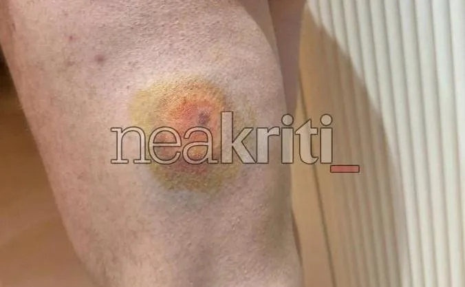 Σοβαρή καταγγελία στην Κρήτη: Η αστυνομία έριξε πλαστικές σφαίρες, πάνω από 10 άνθρωποι πυροβολήθηκαν (εικόνες, vid) 3 image 23