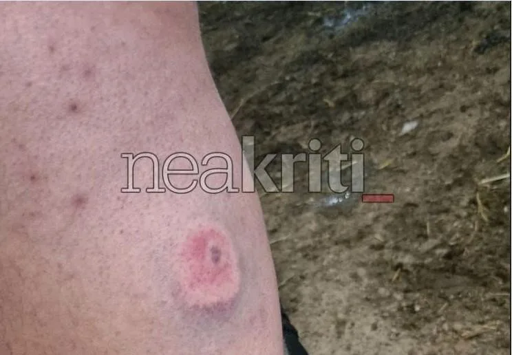 Σοβαρή καταγγελία στην Κρήτη: Η αστυνομία έριξε πλαστικές σφαίρες, πάνω από 10 άνθρωποι πυροβολήθηκαν (εικόνες, vid) 4 image 24