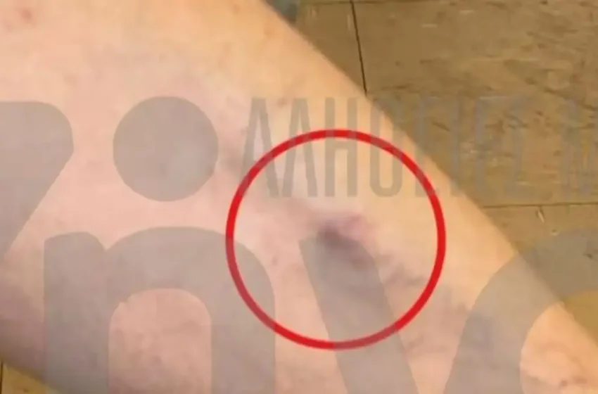  Θριάσιο: Ασθενής καταγγέλλει ξυλοδαρμό από συνοδό άλλου ασθενούς στο θάλαμο νοσηλείας (vid)